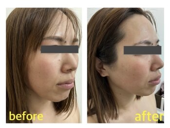 ザ ワン(THE ONE)/美zen筋骨小顔 リフトアップ