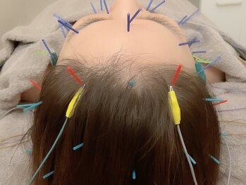 オン 蕨駅西口(ON)/頭皮鍼【白髪/育毛】