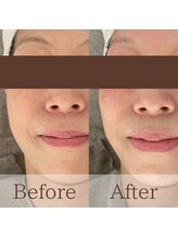 凪眠/小顔リンパフェイシャルの効果6