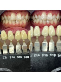トウキョウスワーズ 池袋店(TOKYO SWRS)/#ホワイトニング #池袋 #渋谷