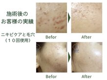 おいかわ整骨院/ハーブピーリングの効果♪