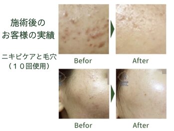 おいかわ整骨院/ハーブピーリングの効果♪