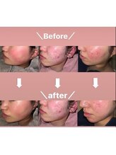 リファラ 光の森店(REFALA)/毛穴・ニキビケア専門REFALA