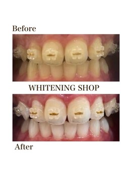 ホワイトニングショップ 岸和田店/お客様のBefore  After