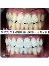 ホワイト 福岡天神店(WHITE)/ホワイトニングビフォーアフター