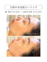 フジモトサロン 那覇おもろまち店(fujimotoサロン)/天使の水光肌ピール
