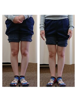 クシロ鍼灸整骨院/【O脚矯正】施術例