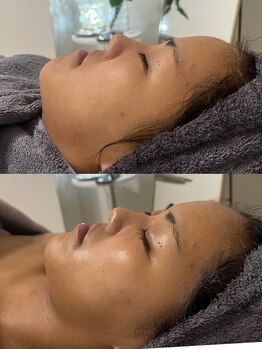 リリー(LILLY)/症例