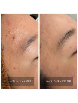 ビビ(VIVI)/繰り返すニキビに