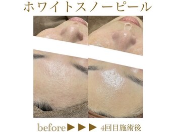 アンドエスビューティ(&S Beauty)/乳酸ピーリング