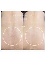 シャロル(SHALOR) 背中ハーブ ピーリング
