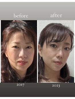 雅菜(miyabina)/うまれかわる。小顔効果