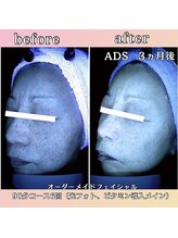 プリマジュール/隠れシミに働きかける！