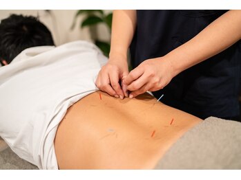 四条大宮アシスト鍼灸整骨院/鍼灸施術