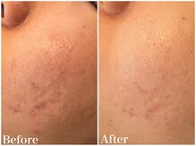 サロンドフェイス(Salon de Faith)/ハーブピーリング