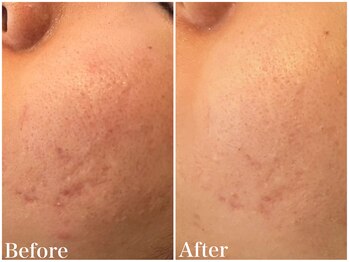 サロンドフェイス(Salon de Faith)/ハーブピーリング