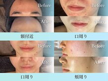 バース(Birth...)の雰囲気（頑固な額、口周り、顎周りのニキビも比べると効果を実感◎）