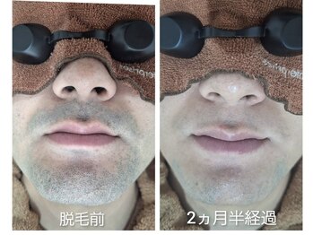 アカラ 読谷店(AKALA)/ヒゲ脱毛2か月半が経過