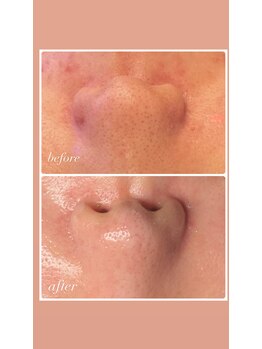 雅菜(miyabina)/毛穴美人へ！ハイドラ毛穴洗浄