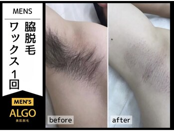 アルゴ 福井店(ALGO)/20代男性 1回目　脇WAX脱毛
