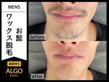 アルゴ 敦賀店(ALGO)/20代男性８回目アルゴ式WAX脱毛