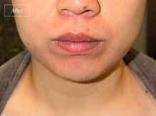 キュレイテッドスキン(CURATED SKIN)/レモンボトル/脂肪分解美容液