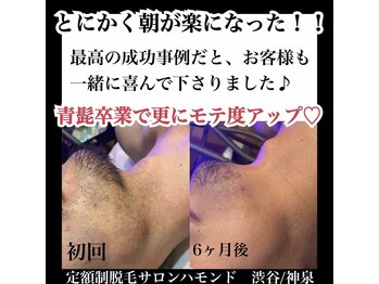 ハモンド(Hammond)/髭脱毛