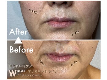 シストワ(sistoi)/《Before→After》