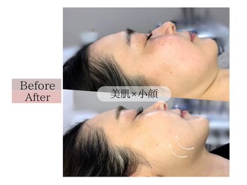 フロリール アザブジュウバン(FlorirAzabujuban)/幹細胞導入＋造顔フェイシャル