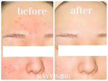 レイビス 郡山店(RAYVIS)/トーンアップ+毛穴+ニキビケア