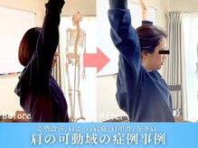 鍼灸整体院ワト 三軒茶屋院(鍼灸整体院WATO)/ ■肩の可動域症例事例