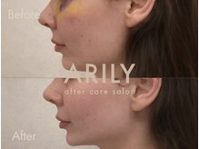 アリリィ(ARILY)/ダウンタイムケア/表参道/外苑前