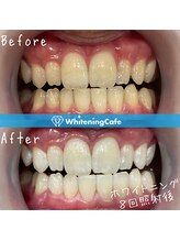 ホワイトニングカフェ 平塚店(WhiteningCafe)/◎歯のホワイトニング施術写真◎