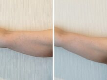 リテルナ(Re.terna)/■脂肪分解溶液+マッサージ