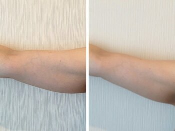 リテルナ(Re.terna)/■脂肪分解溶液+マッサージ