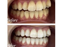 ホワイト 福岡博多店(WHITE)/ホワイトニング通い放題ビフォー