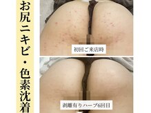 VIO以外、全ての箇所の施術可能！体のハーブピーリング大人気！