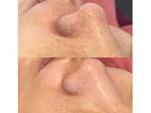 エミルカ 神戸三宮(EMILUCA)/毛穴レスに！