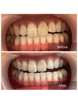 ライエ(Raie)/Before After