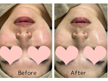 TD 江南店/初めてのハーブピーリング