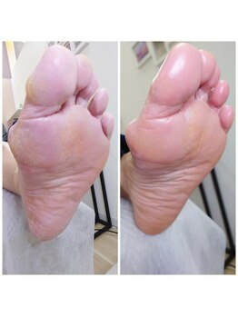 リゼラアンドコー 鹿沼店/フットキュアコース