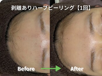 リソルバイスリール(Re:sol by sourire)/毛穴洗浄・ハーブピーリング専門