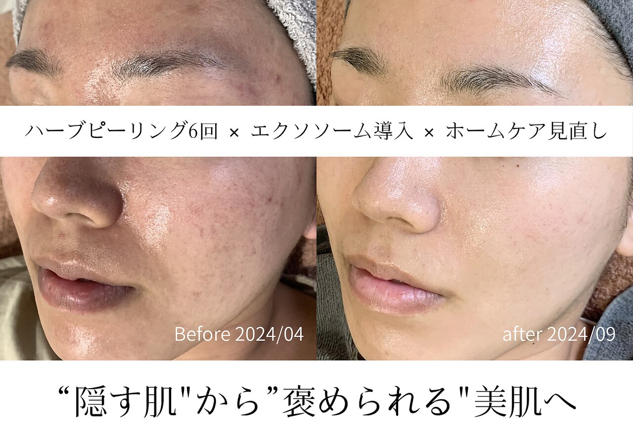 5ページ目｜リンパボーラーに関するエステサロン 小顔・毛穴