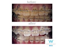 ホワイトニングショップ 越谷店/【矯正中の方でも◎】