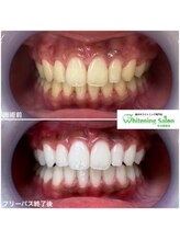 ホワイトニングサロン 名古屋駅店/【ホワイトニング施術例】