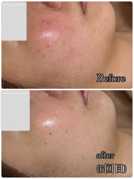 メロー(MELLOW)/ハーブピーリング(赤み/敏感肌)