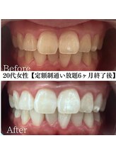 ホワイト 福岡天神店(WHITE)/ホワイトニングビフォーアフター
