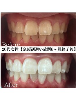 ホワイト 福岡天神店(WHITE)/ホワイトニングビフォーアフター