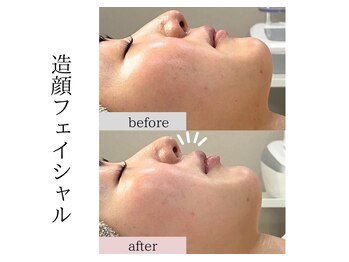 フロリール アザブジュウバン(FlorirAzabujuban)/3D小顔/造顔フェイシャル