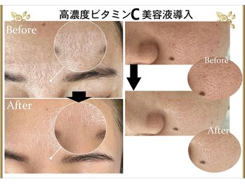 サロンフィーユ(Fille)/毛穴洗浄「引き締め効果!!◎」